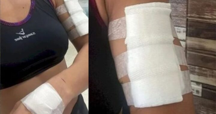 Rincón: una mujer fue atacada por un perro mientras hacía ejercicio